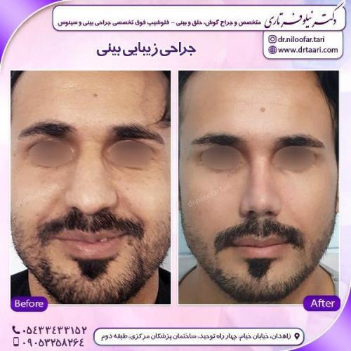 جراحی-بینی-74