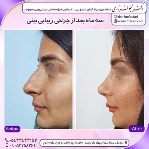 جراحی-بینی-76