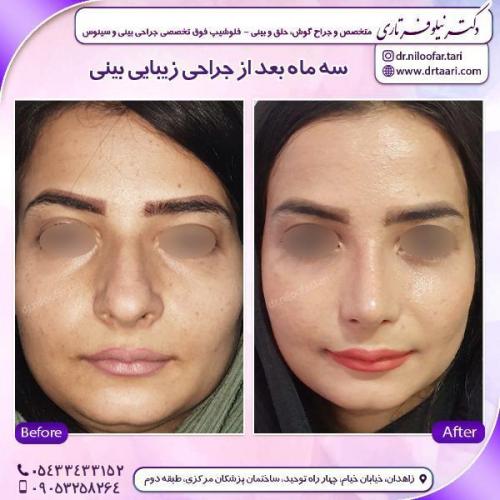 جراحی-بینی-78