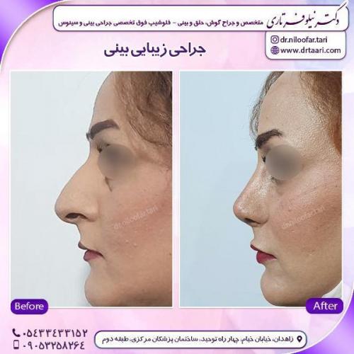 جراحی-بینی-80
