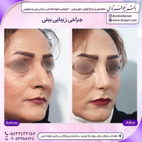 جراحی-بینی-81