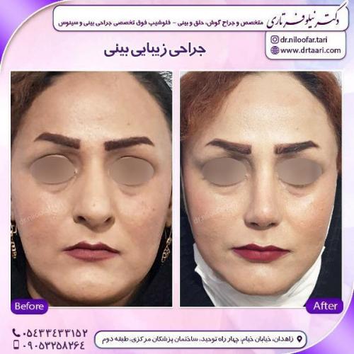 جراحی-بینی-82