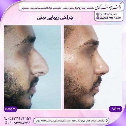 جراحی-بینی-83