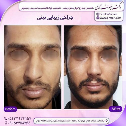 جراحی-بینی-84