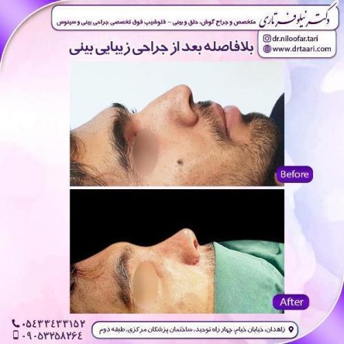جراحی-بینی-85