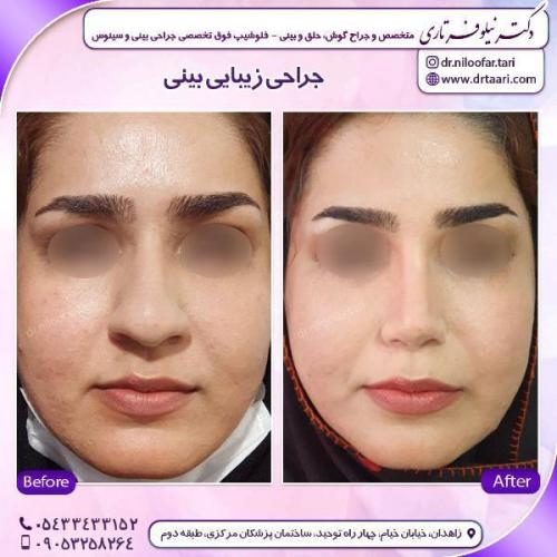 جراحی-بینی-87