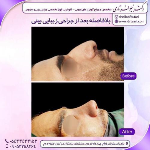 جراحی-بینی-89