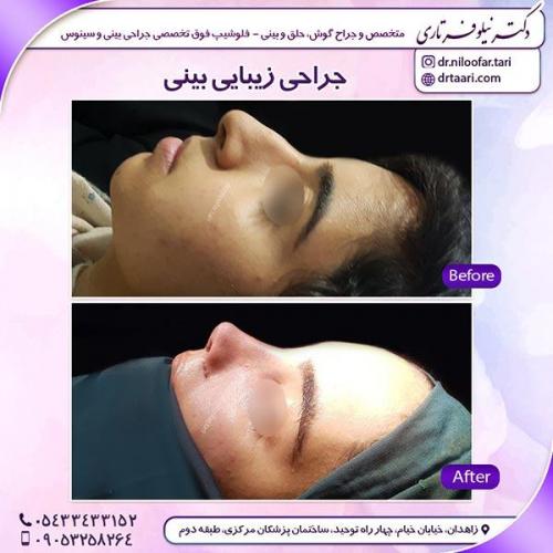 جراحی-بینی-9