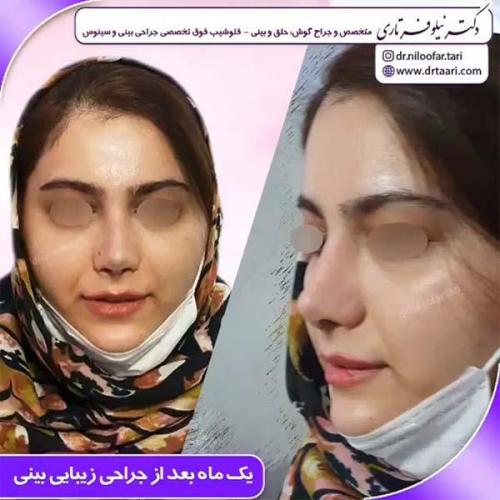 جراحی-بینی-90