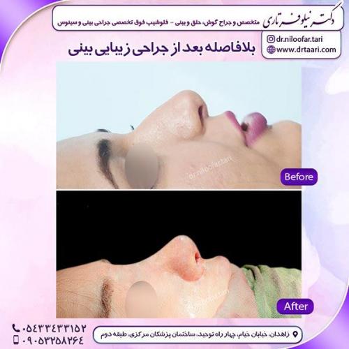 جراحی-بینی-94
