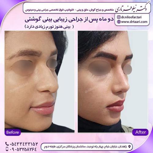 جراحی-بینی-95