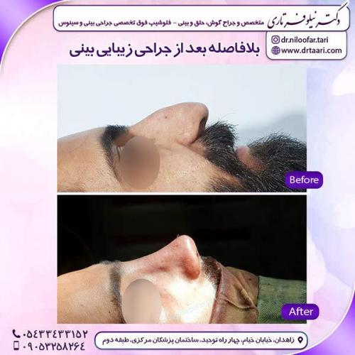 جراحی-بینی-96