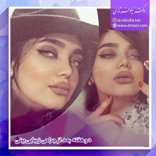 جراحی-بینی-97