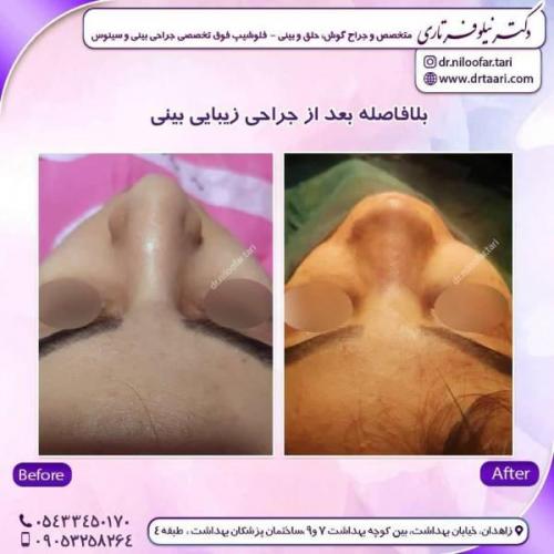 جراحی-بینی-زاهدان-100
