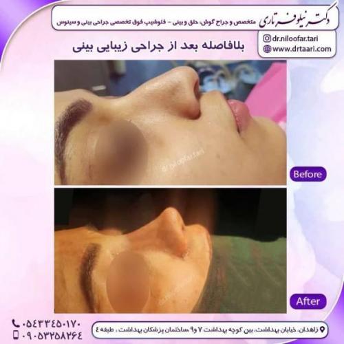 جراحی-بینی-زاهدان-101