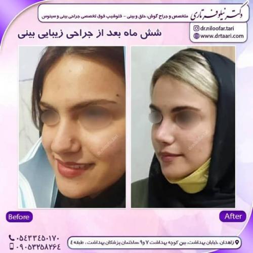 جراحی-بینی-زاهدان-105