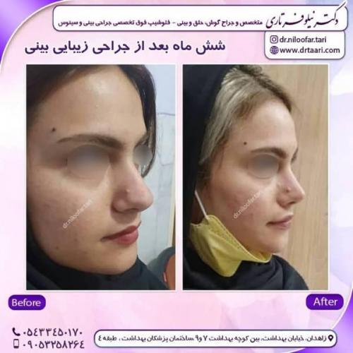جراحی-بینی-زاهدان-106