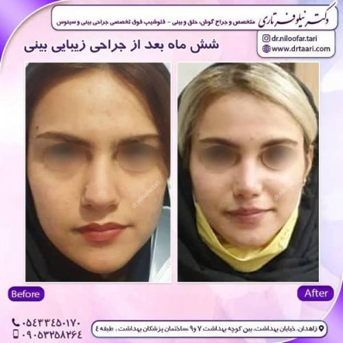 جراحی-بینی-زاهدان-107