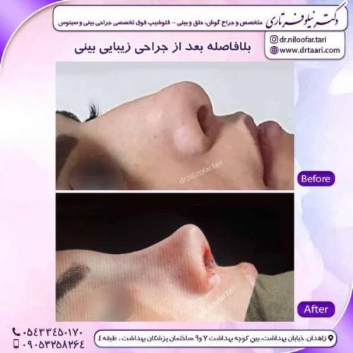 جراحی-بینی-زاهدان-108