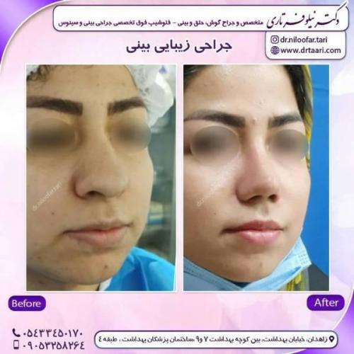 جراحی-بینی-زاهدان-109