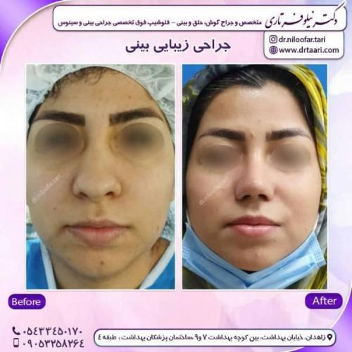 جراحی-بینی-زاهدان-110