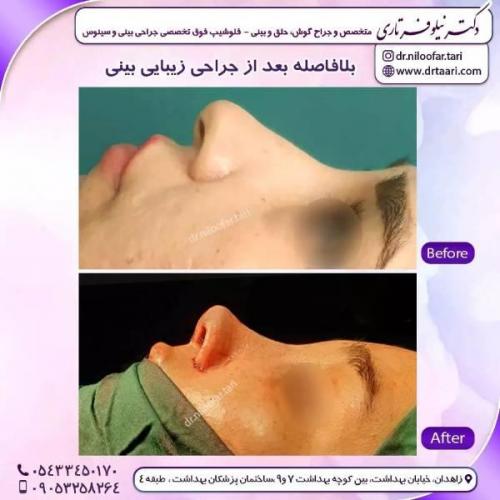 جراحی-بینی-زاهدان-111
