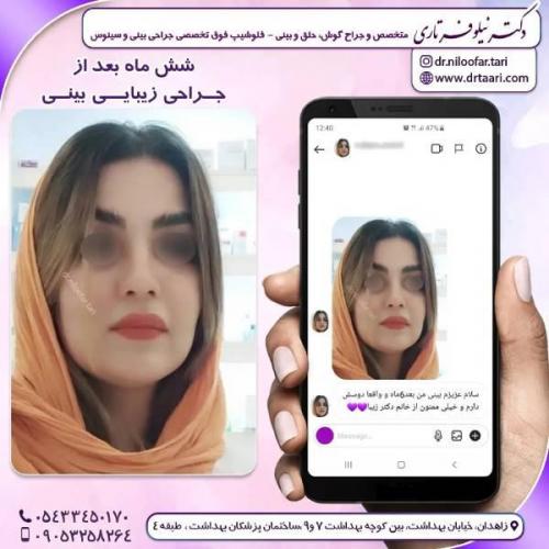 جراحی-بینی-زاهدان-115