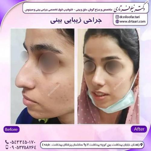 جراحی-بینی-زاهدان-117