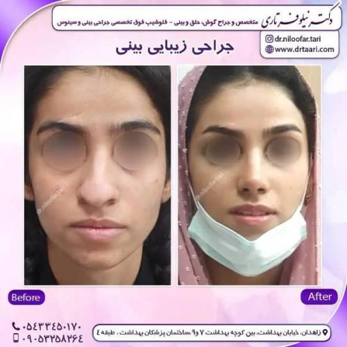 جراحی-بینی-زاهدان-118