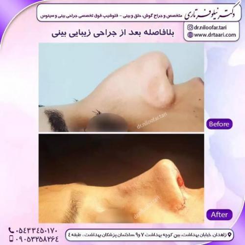 جراحی-بینی-زاهدان-119