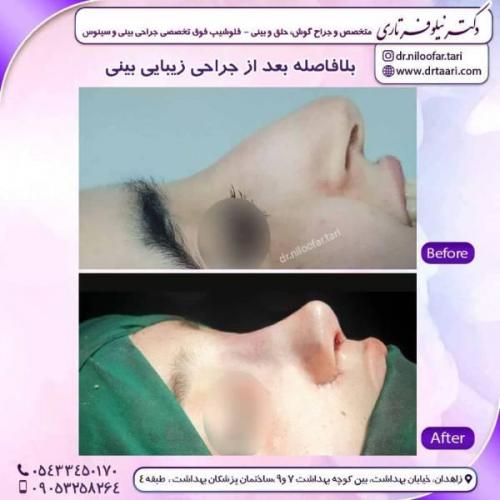 جراحی-بینی-زاهدان-122