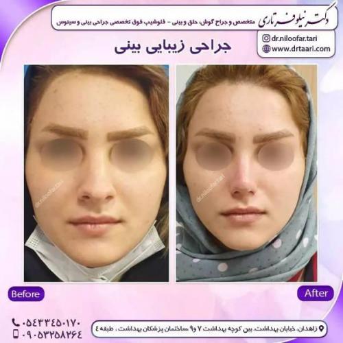 جراحی-بینی-زاهدان-127