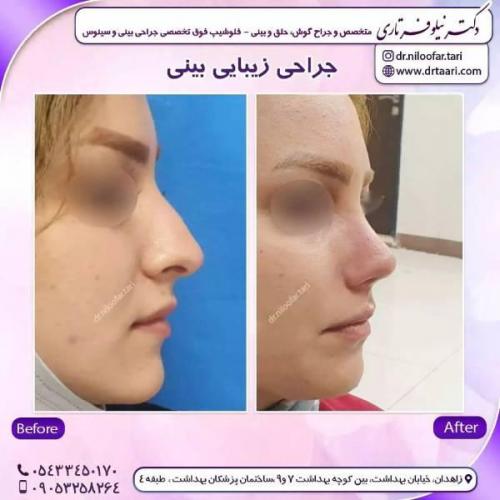 جراحی-بینی-زاهدان-128