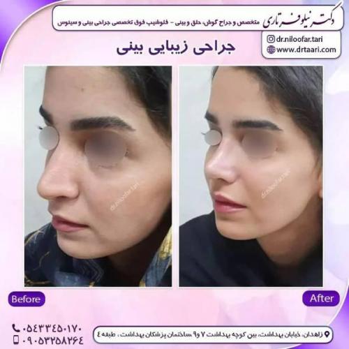 جراحی-بینی-زاهدان-129