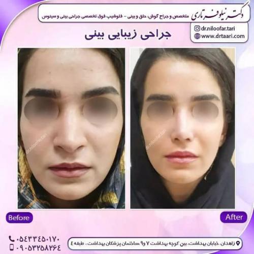جراحی-بینی-زاهدان-130