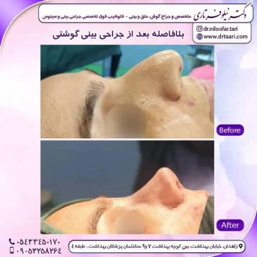 جراحی-بینی-زاهدان-131