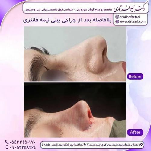 جراحی-بینی-زاهدان-132