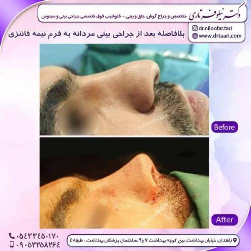 جراحی-بینی-زاهدان-134