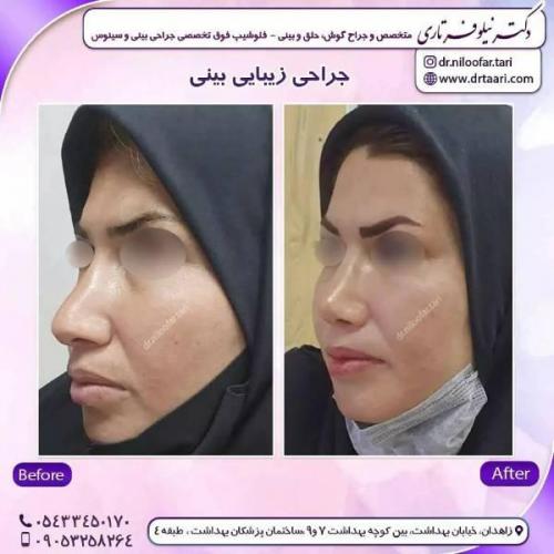 جراحی-بینی-زاهدان-140