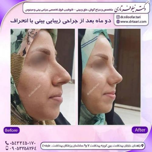 جراحی-بینی-زاهدان-147
