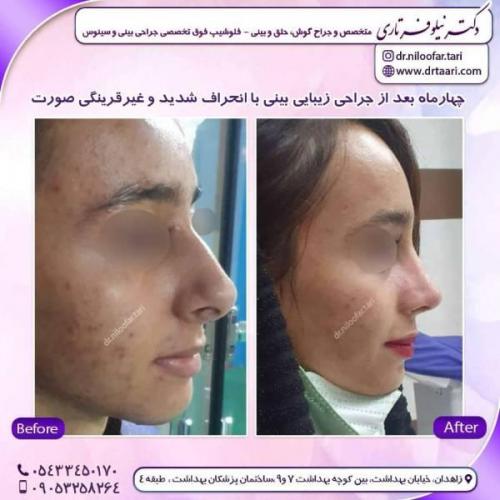 جراحی-بینی-زاهدان-149
