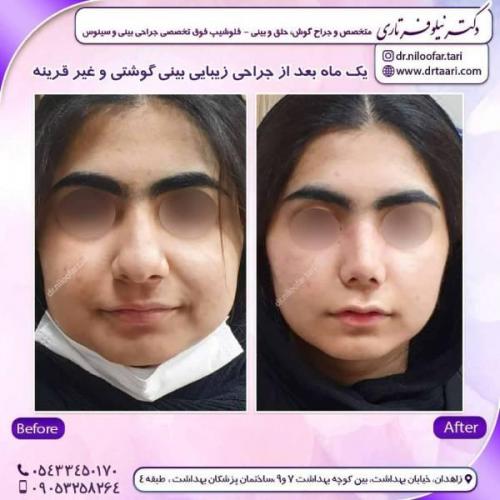 جراحی-بینی-زاهدان-151