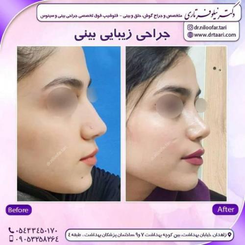 جراحی-بینی-زاهدان-153