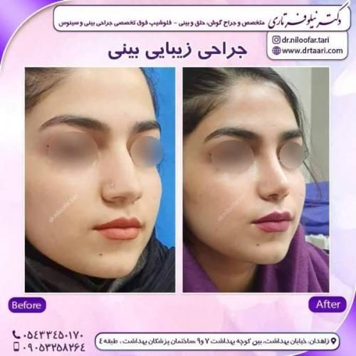 جراحی-بینی-زاهدان-154