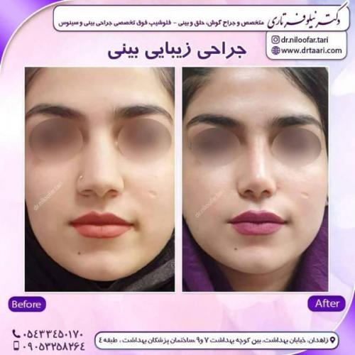 جراحی-بینی-زاهدان-155