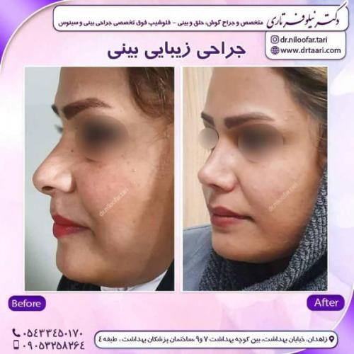 جراحی-بینی-زاهدان-157