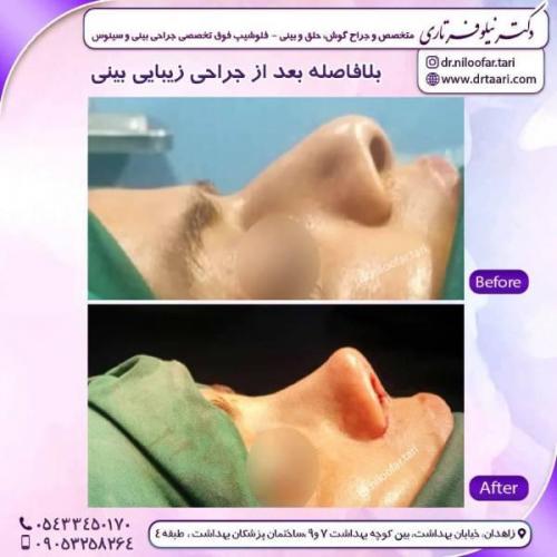 جراحی-بینی-زاهدان-158