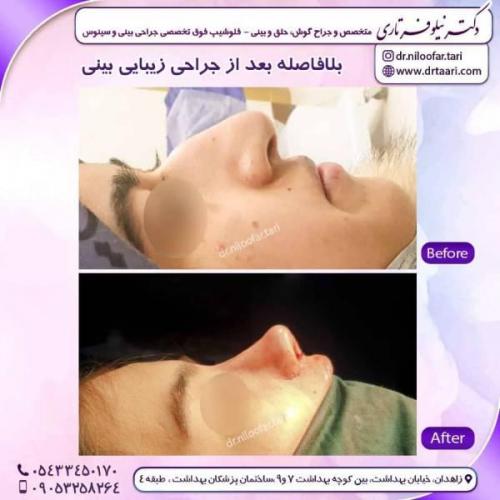 جراحی-بینی-زاهدان-176