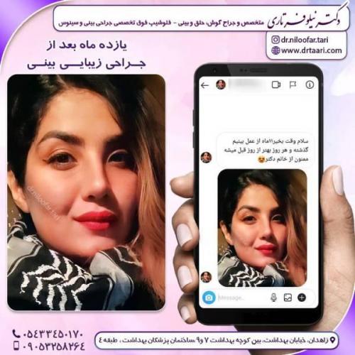 جراحی-بینی-زاهدان-180