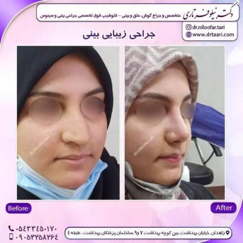 جراحی-بینی-زاهدان-185